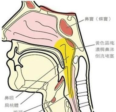 為什麼有人的痰總是咳不完咽喉部受到炎症的刺激同樣出現分泌物增多的