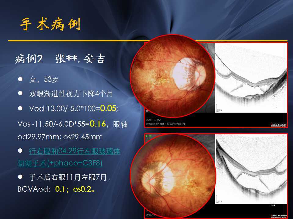 高度近視黃斑劈裂