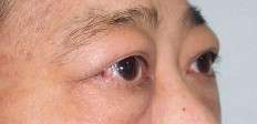 甲状腺相关性眼病(甲亢突眼)的诊治