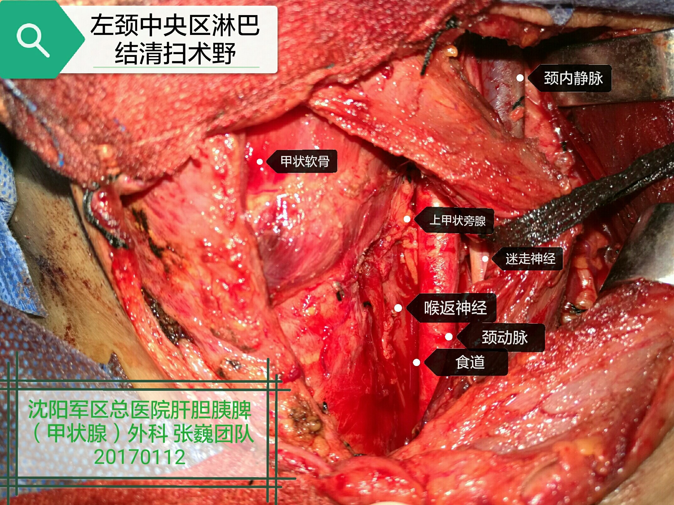 甲状腺癌B超图片图片