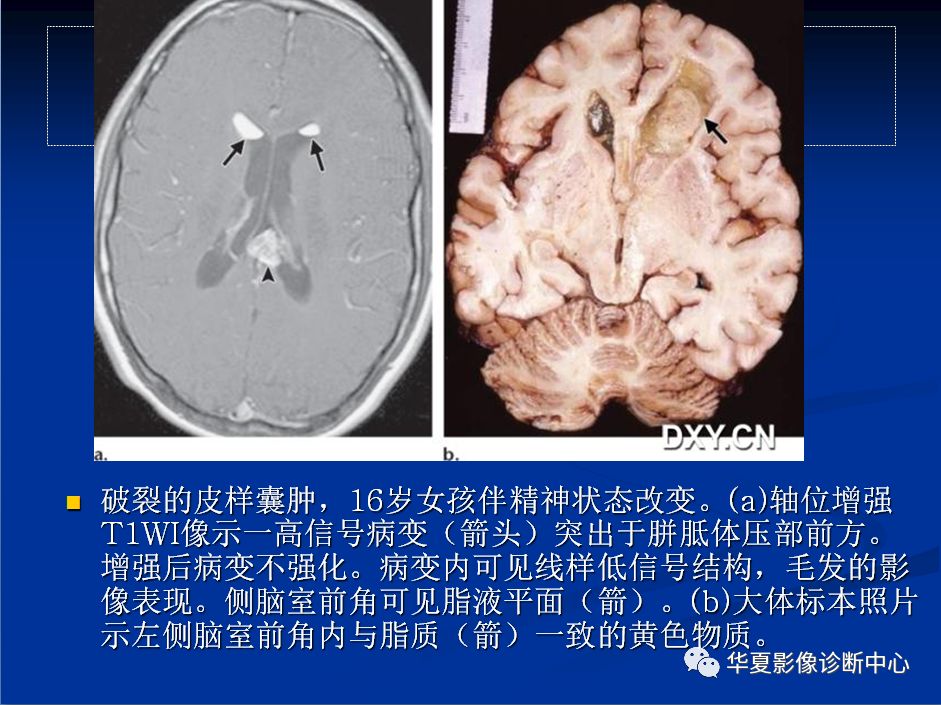 松果体层面MRI图图片