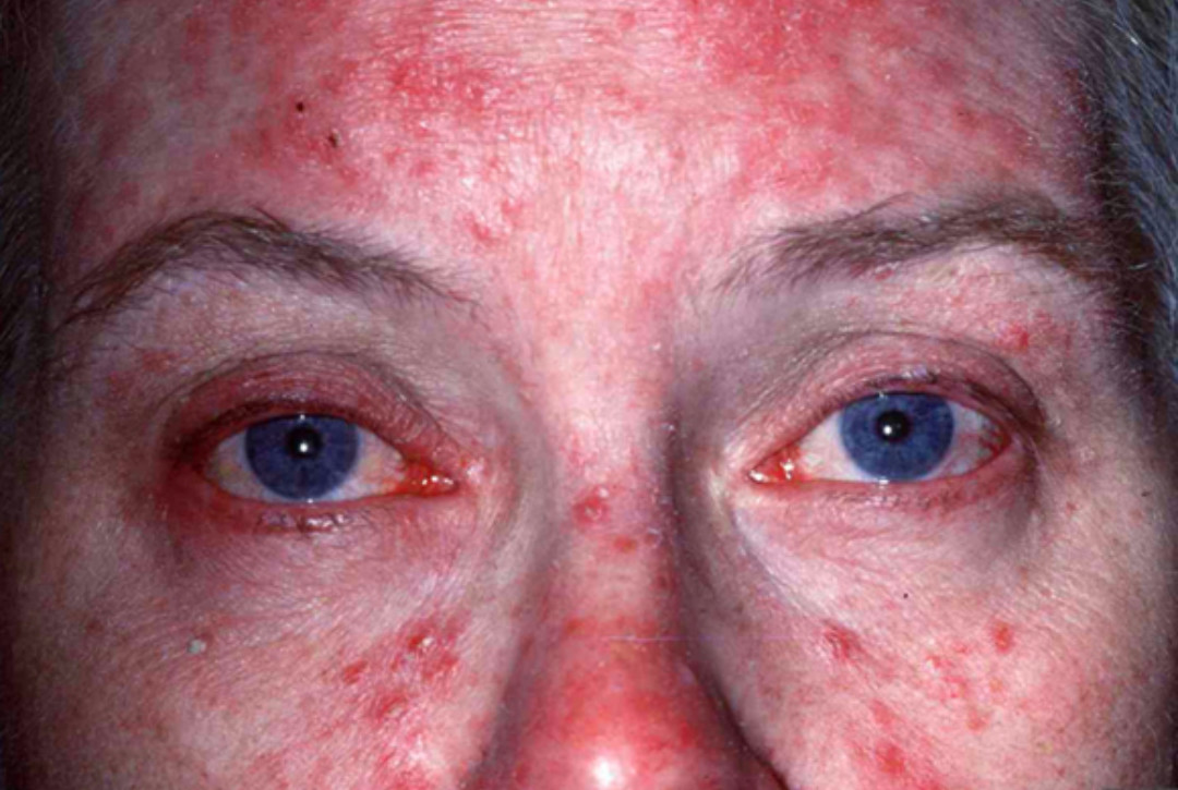 可以理解为是面部过敏和痘痘的情况合并存在的一种疾病了