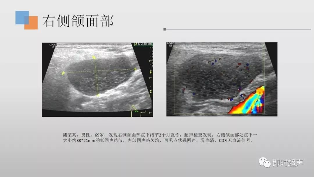 表皮样囊肿超声声像图图片