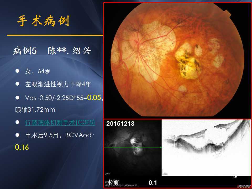 高度近視黃斑劈裂