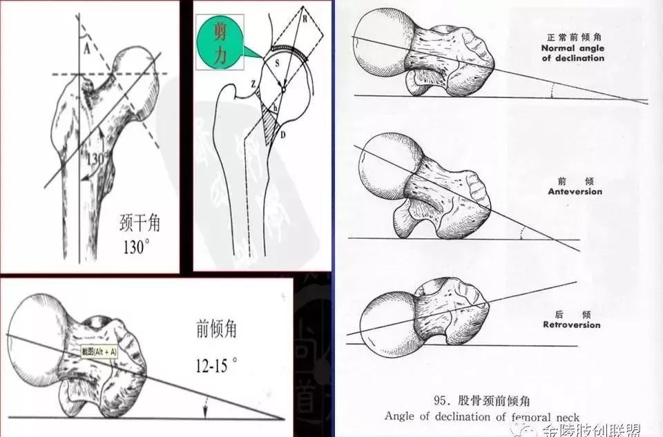 髋臼前倾角图片