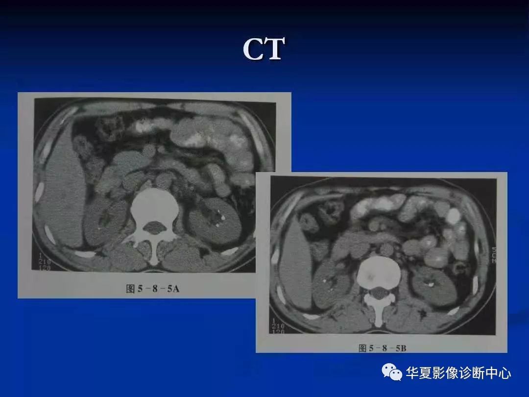 髓质海绵肾CT图片