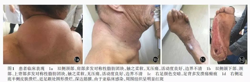 以中樞神經系統和周圍神經系統損害為臨床表現的多發對稱性脂肪瘤病一