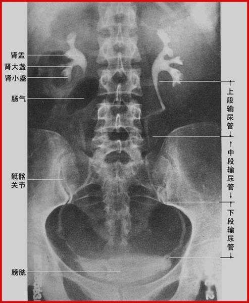 输尿管痉挛图片