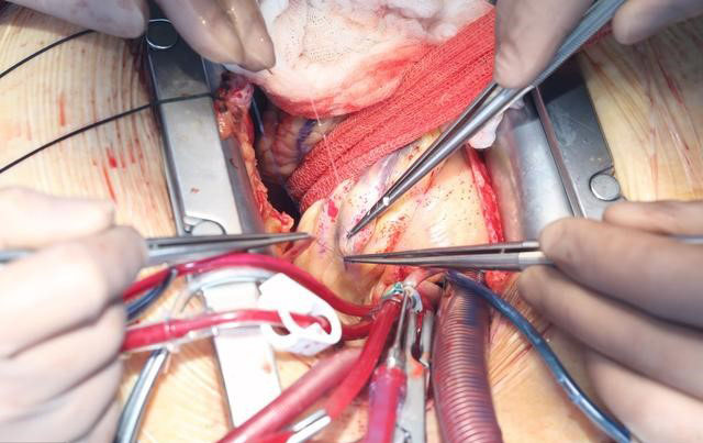 心脏搭桥手术过程图片