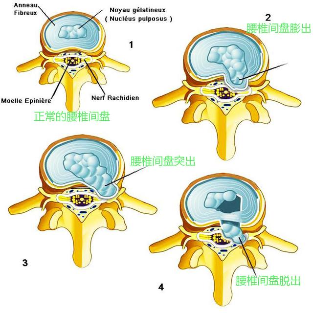 腰间盘突出的原理图解图片