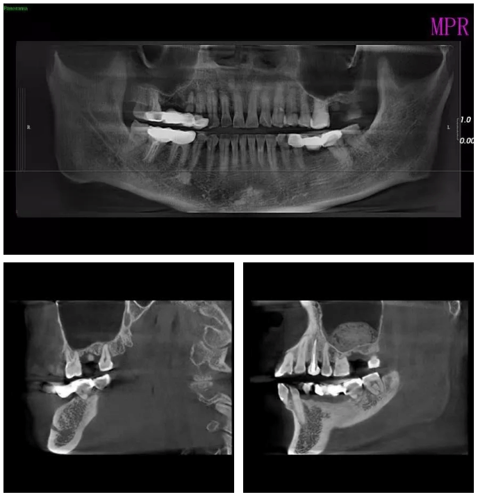 左上7骨量高度低于4mm;ct影像,47岁, 牙齿缺失及烤瓷冠套松动
