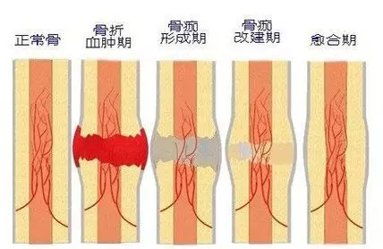 骨折愈合过程 示意图图片