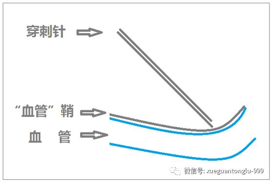 (6)反覆穿刺,依然無法突破