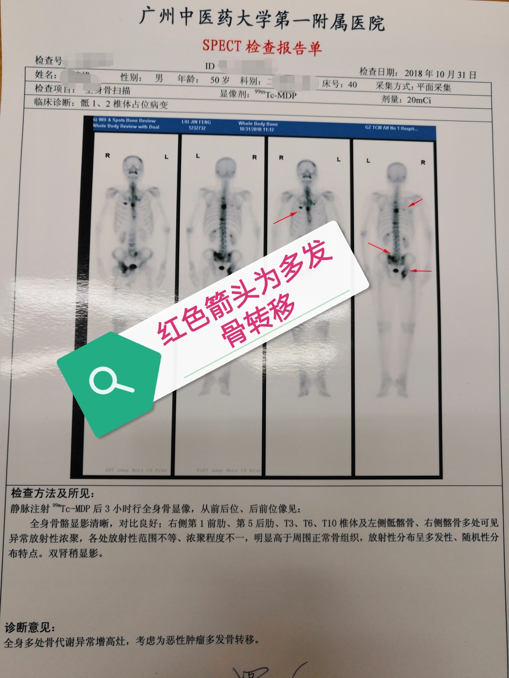 肺癌检查报告单图片 ct图片