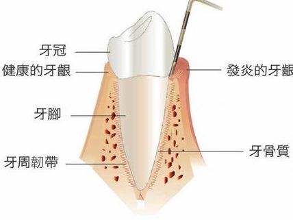 引起牙髓炎的原因及治療方式!_牙齒