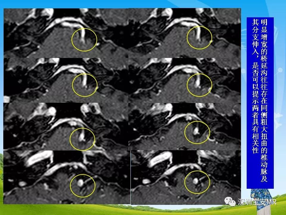 橋池段面神經與鄰近血管的mr成像研究