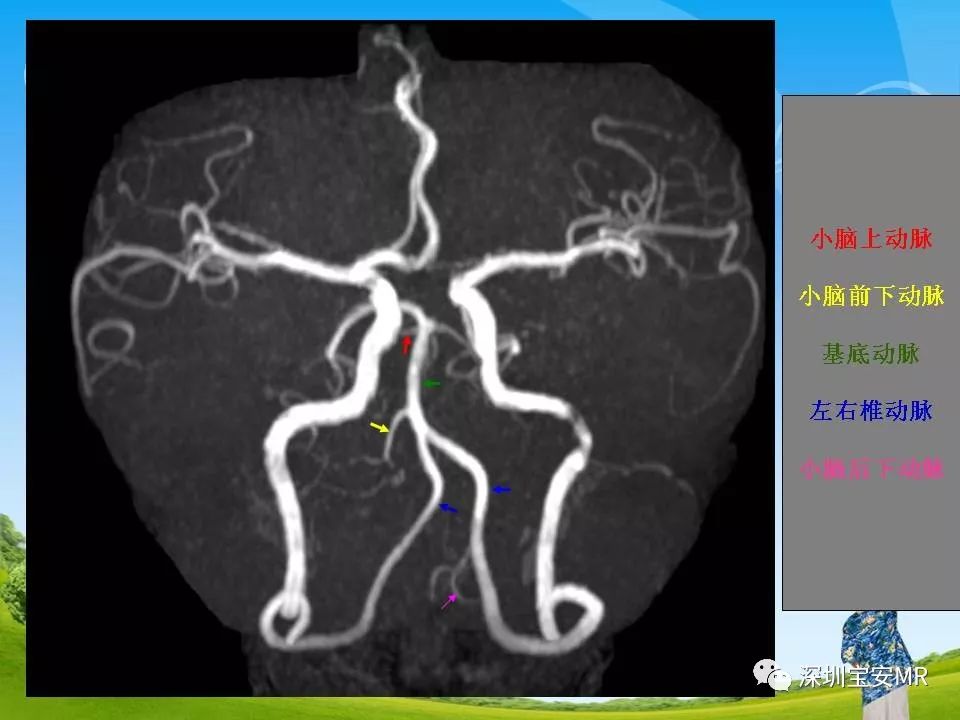 头颅血管成像图解图片