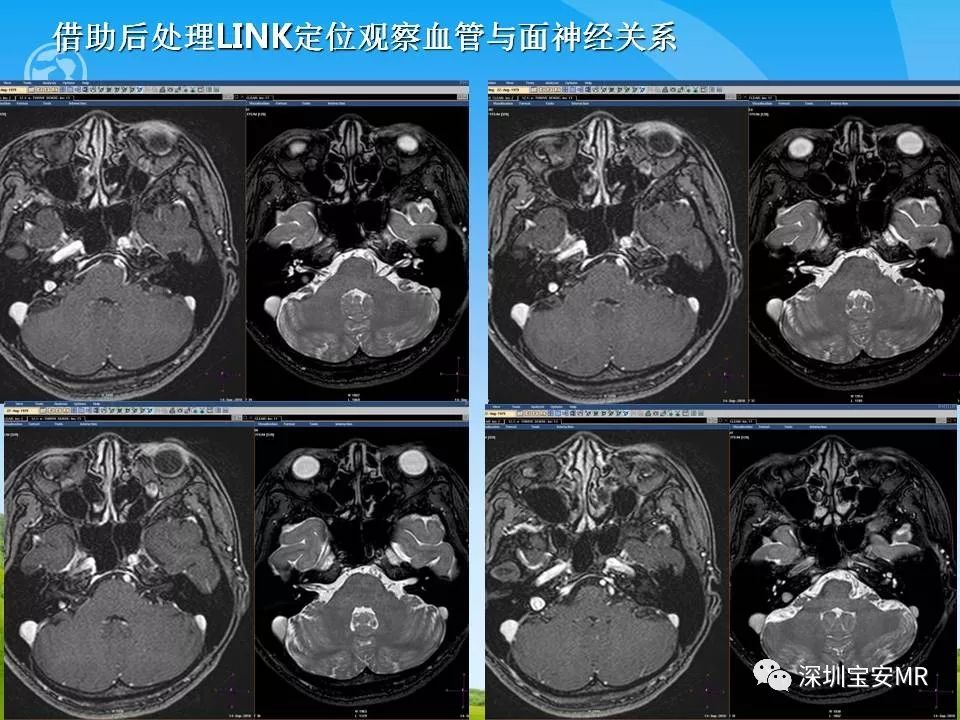 桥池段面神经与邻近血管的mr成像研究