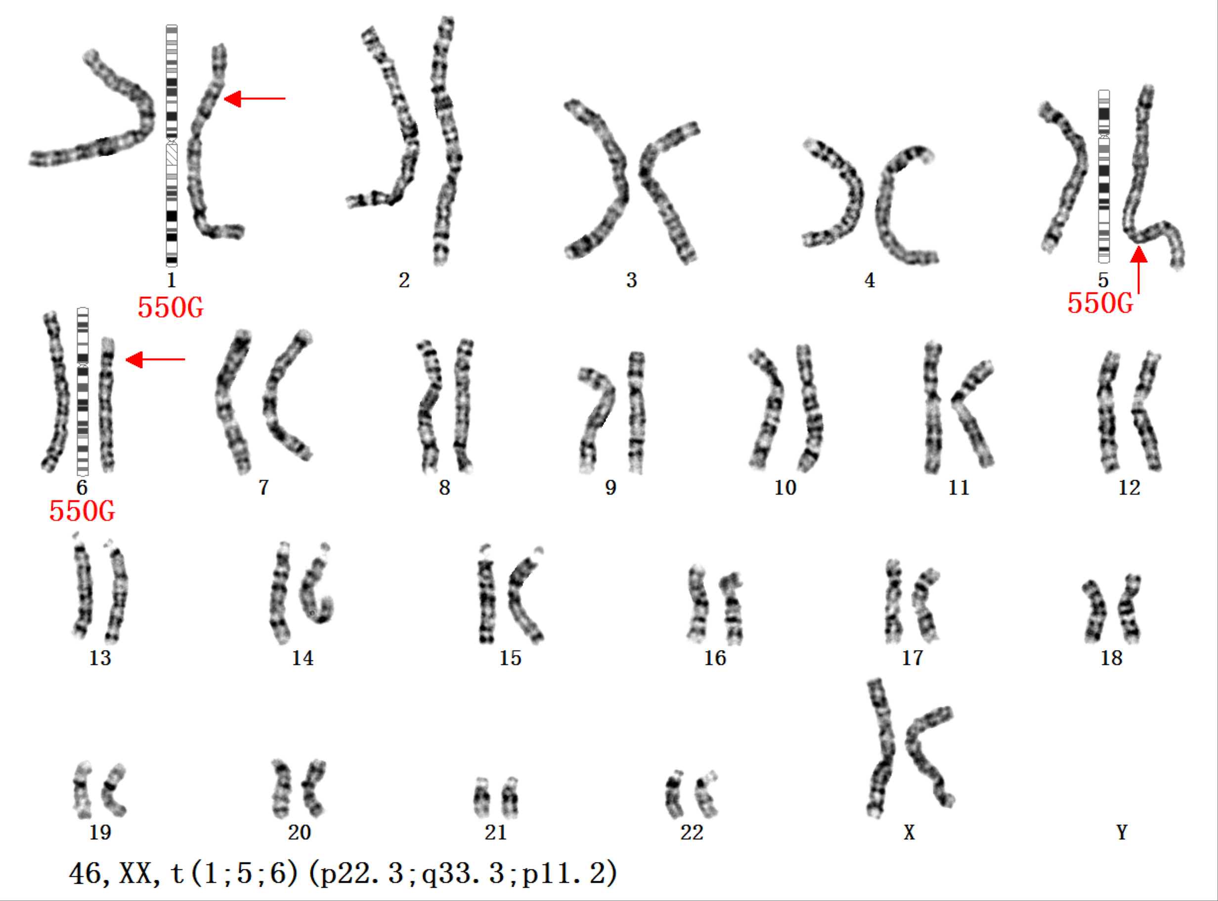 染色体结构畸变简式图片