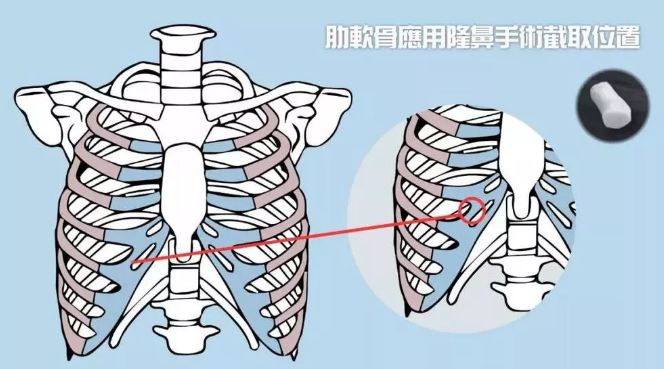 恢復完全後,身體功能不會受到限制. 取肋軟骨會留下多大的疤?