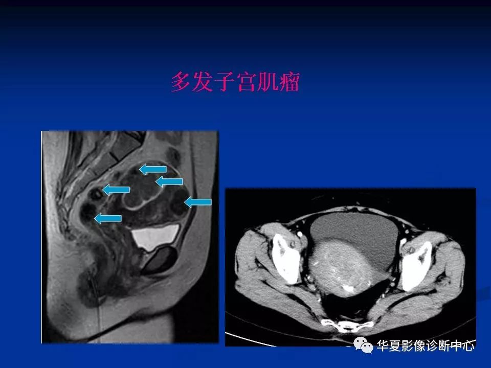 女性盆腔解剖及常見病變的mri診斷