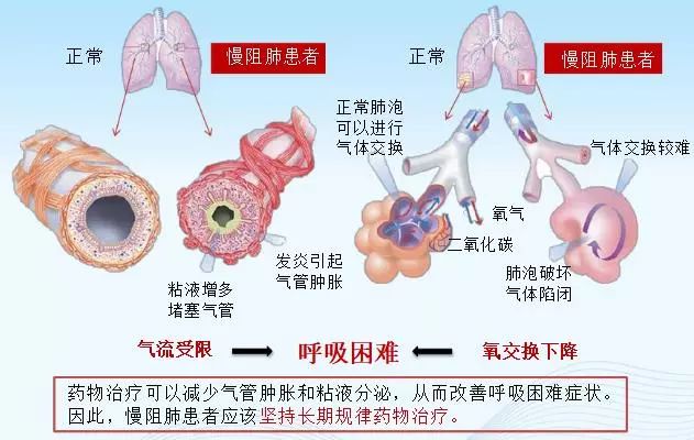 吉林医药学院附属医院世界慢阻肺日义诊及健康宣教活动关注慢阻肺永远