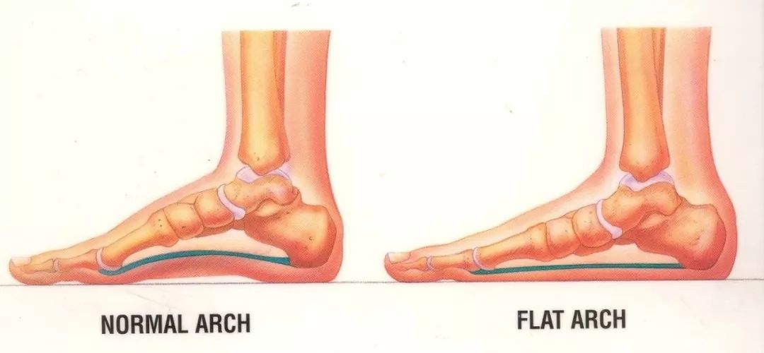 扁平足也想跑步該如何安排