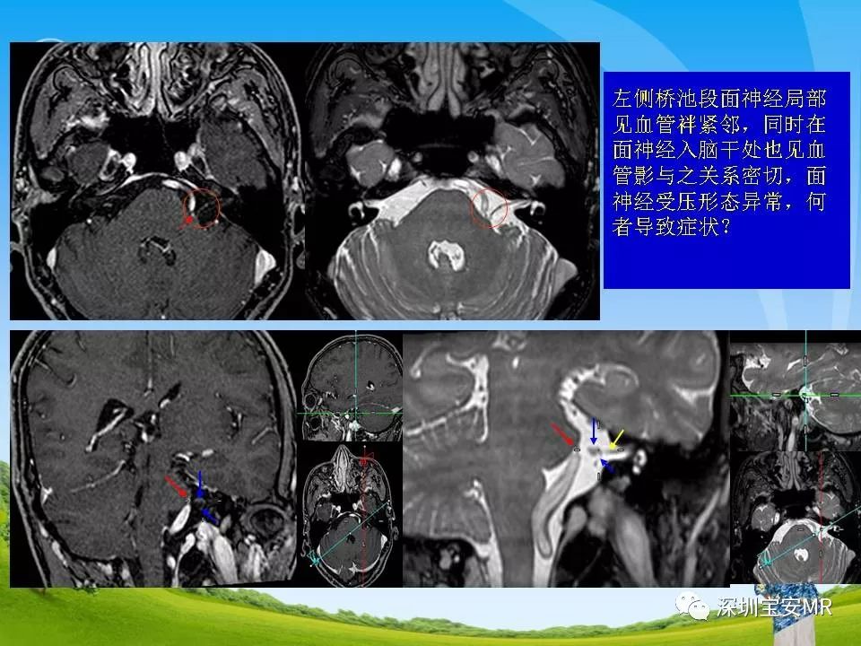 橋池段面神經與鄰近血管的mr成像研究