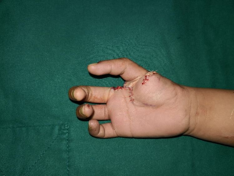 小儿麻痹导致手畸形图片