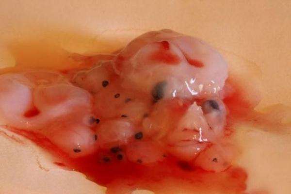 流出来的胚胎组织图片图片