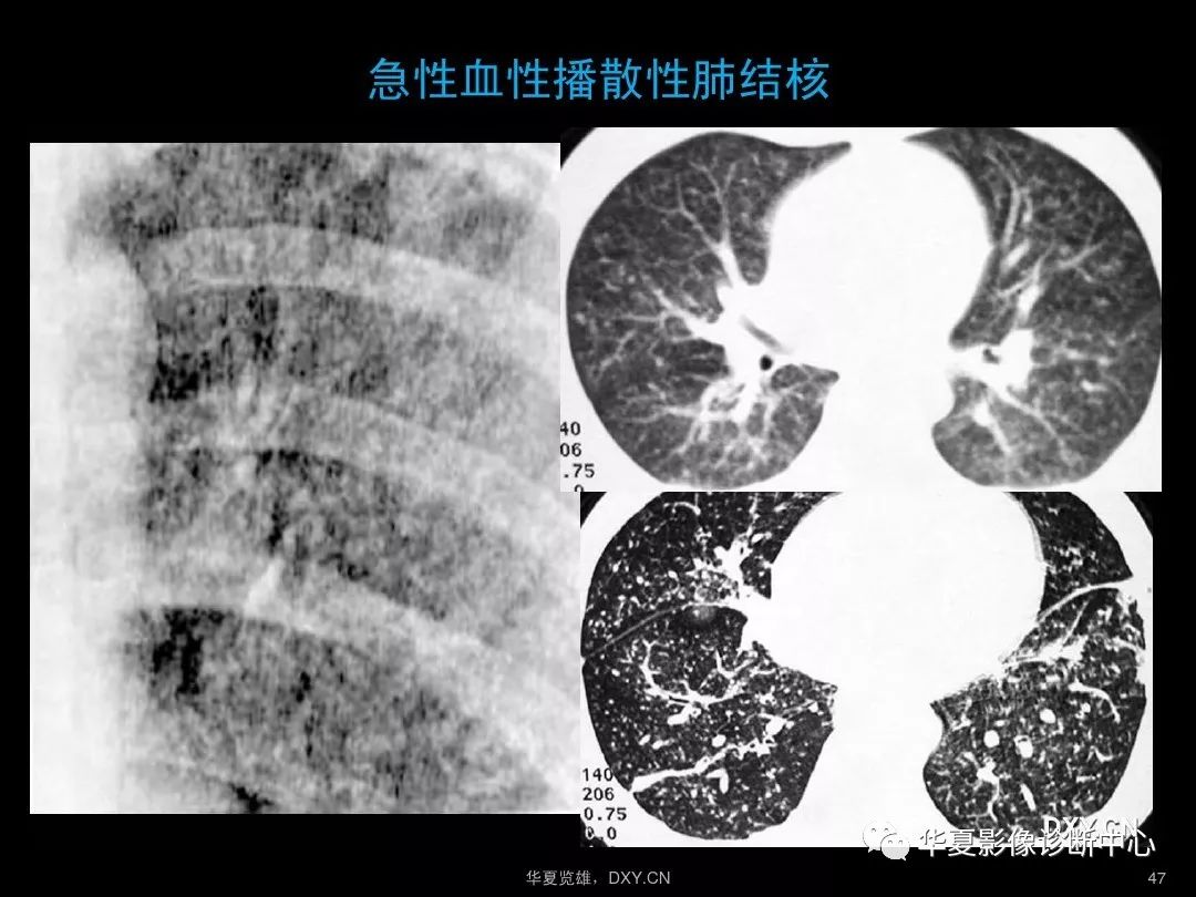 肺炎肺結核肺癌在ct及胸片上的區別