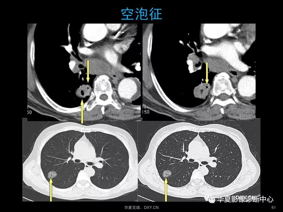 肺炎ct片图片图解图片