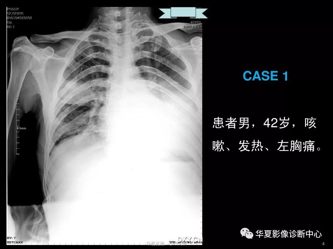 肺炎肺結核肺癌在ct及胸片上的區別