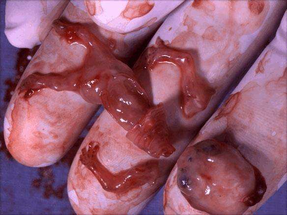 45天流产胚胎的图片图片