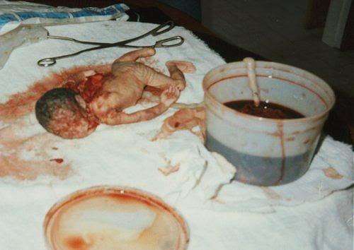 堕胎胎儿图片图片