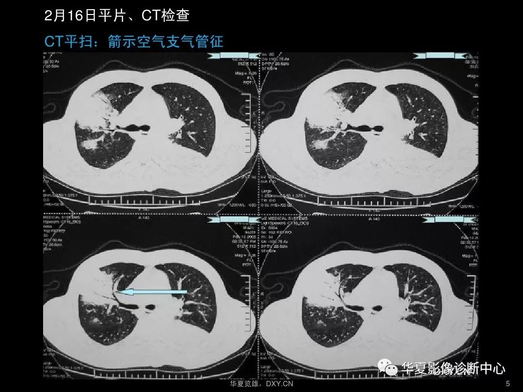 肺炎肺结核肺癌在ct及胸片上的区别