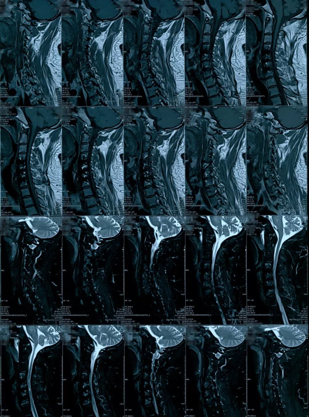 脊髓型颈椎病磁共振图片
