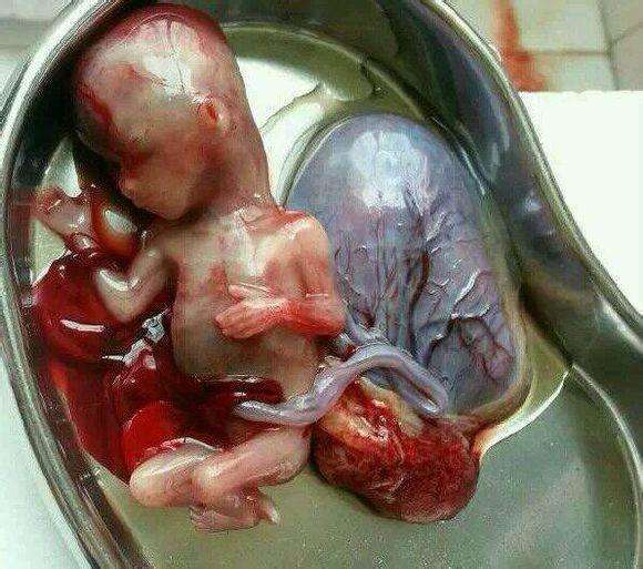 流产胚胎图片
