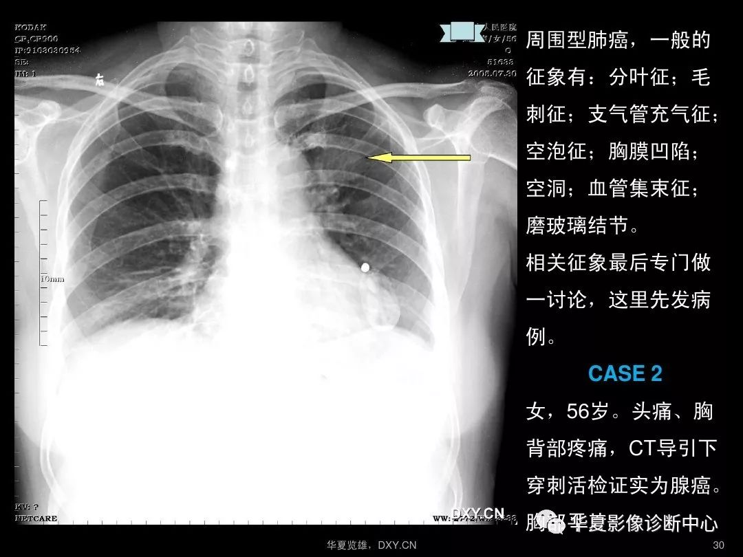 ct平扫胸片怎么看图解图片