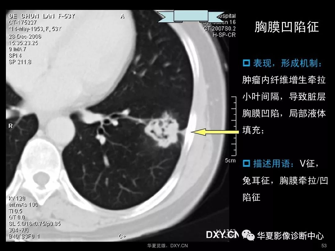 肺结核肺癌ct图片图解图片