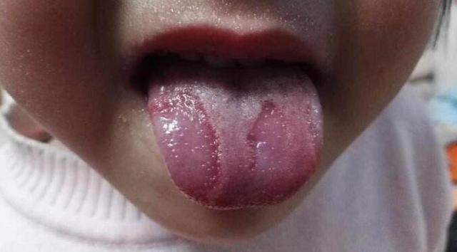 宝宝重舌子的症状图片图片