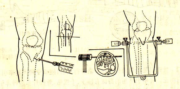 胫骨结节骨牵引术步骤图片