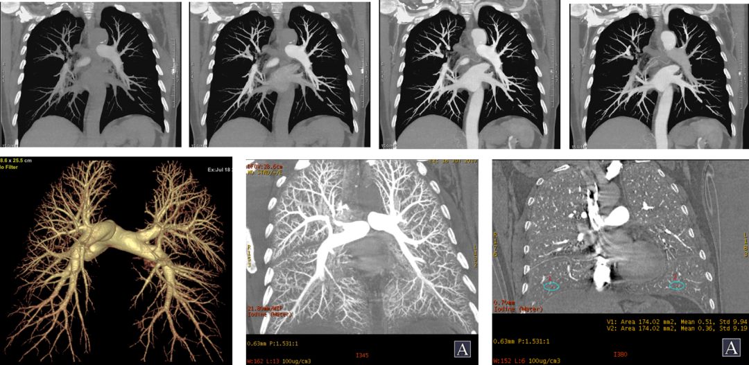 肺动脉ct图像图片