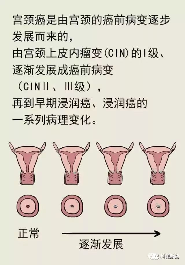 宫颈癌1期图片图片