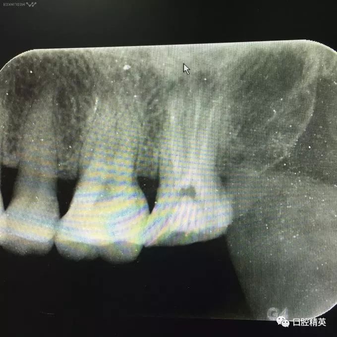 左上第二磨牙牙隐裂至慢性牙髓炎一例