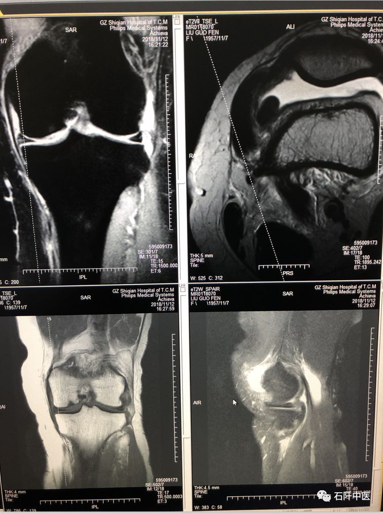經左膝關節核磁共振mri示:1.