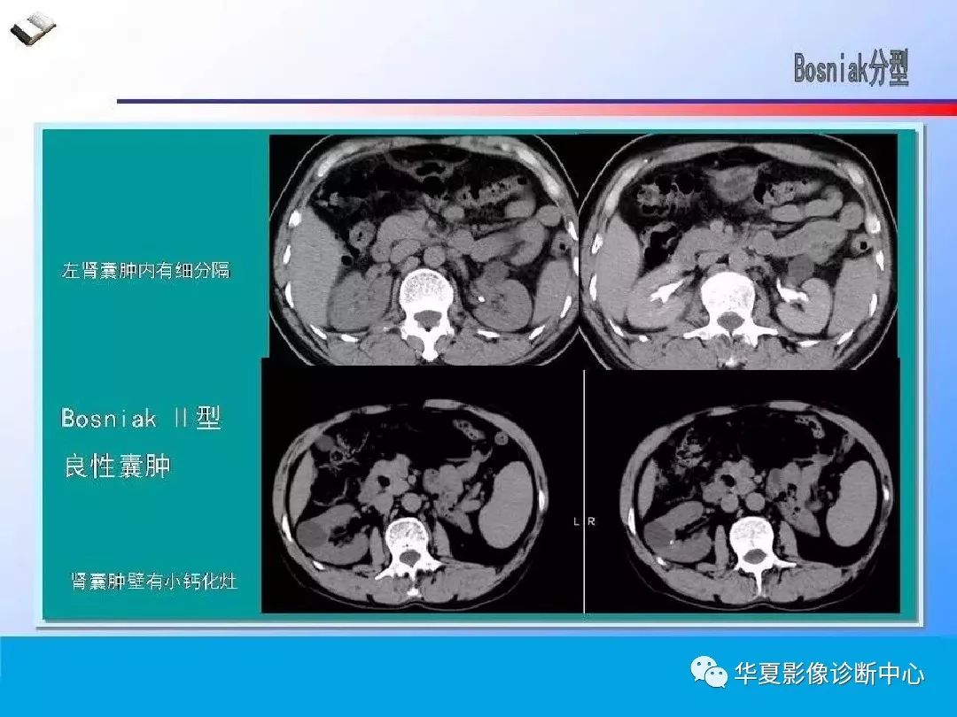 肾脏囊性病变的ct诊断与鉴别诊断