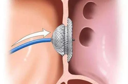 房间隔缺损介入封堵图片