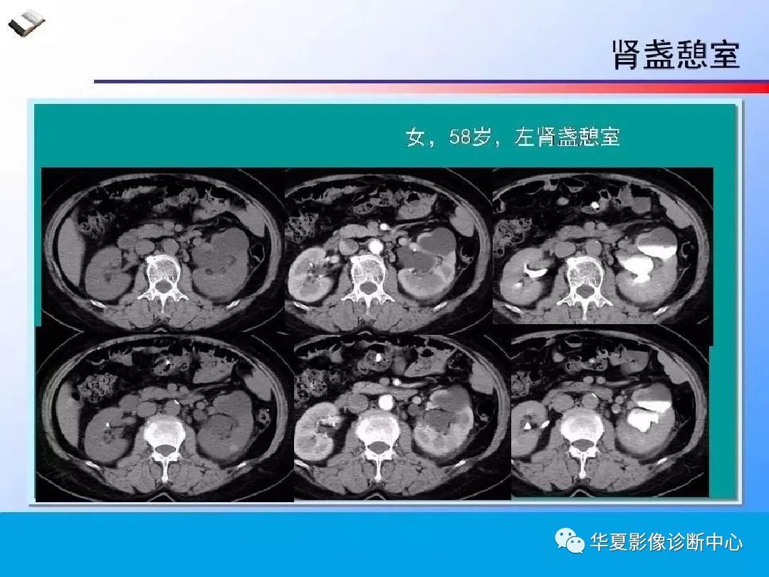 腎臟囊性病變的ct診斷與鑑別診斷