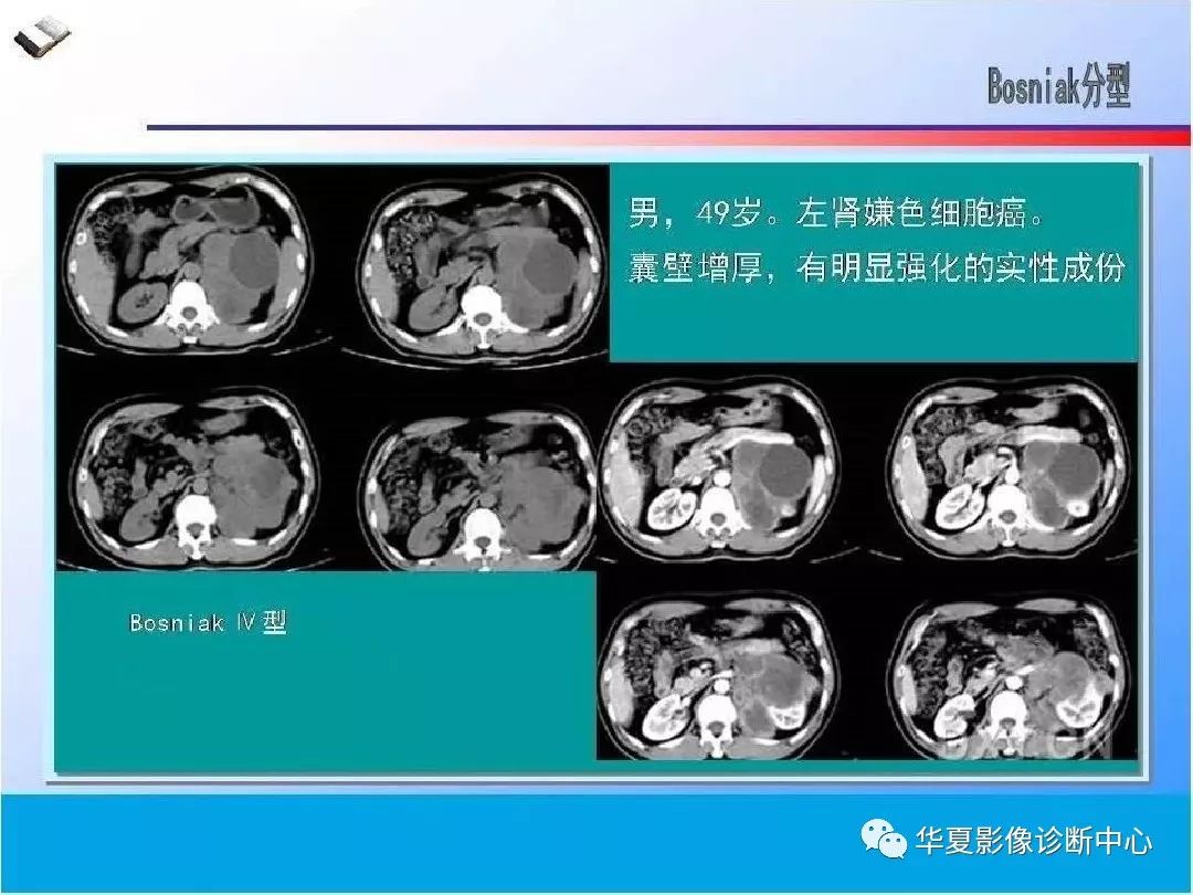 肾脏囊性病变的ct诊断与鉴别诊断